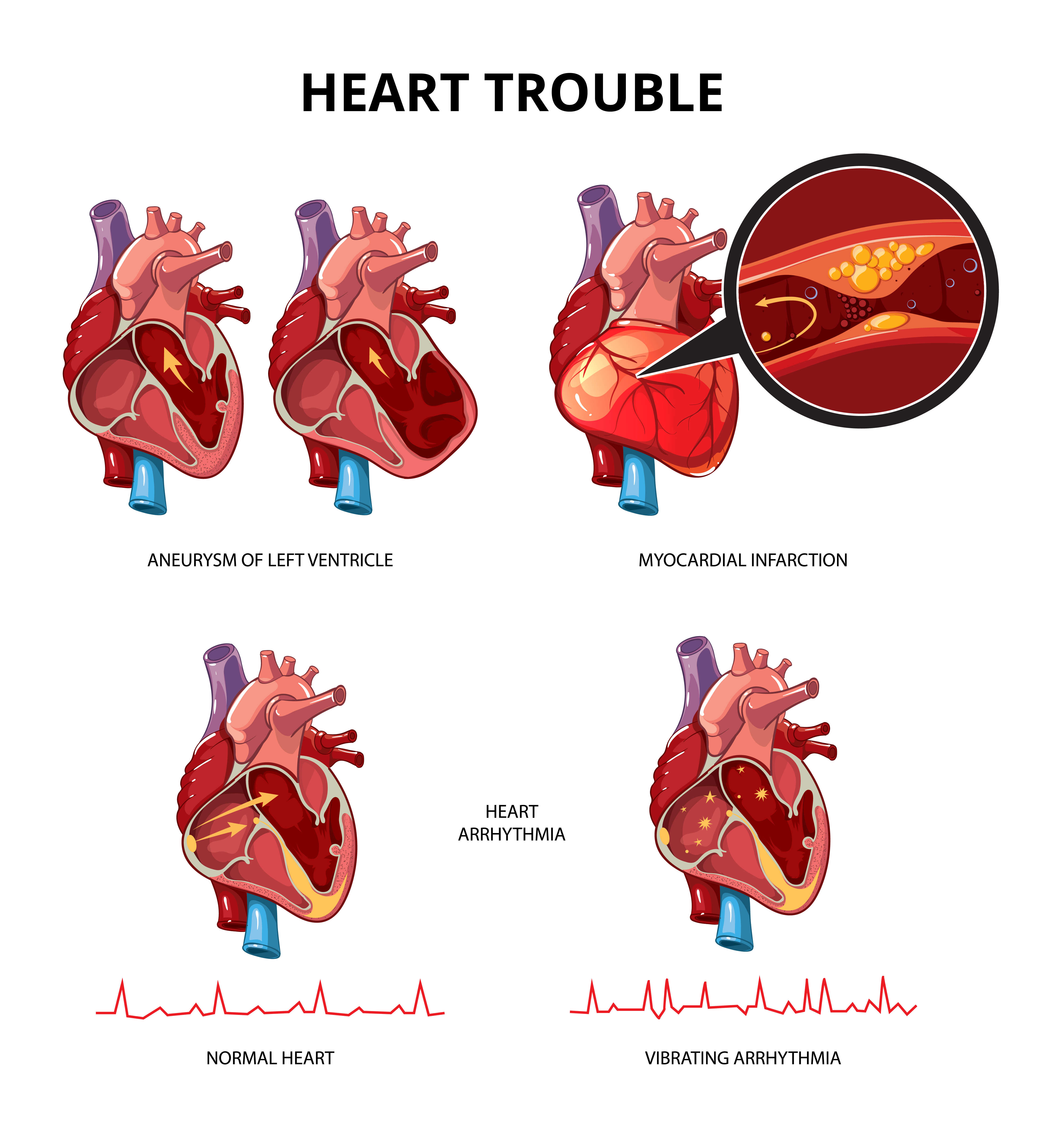 heart disease