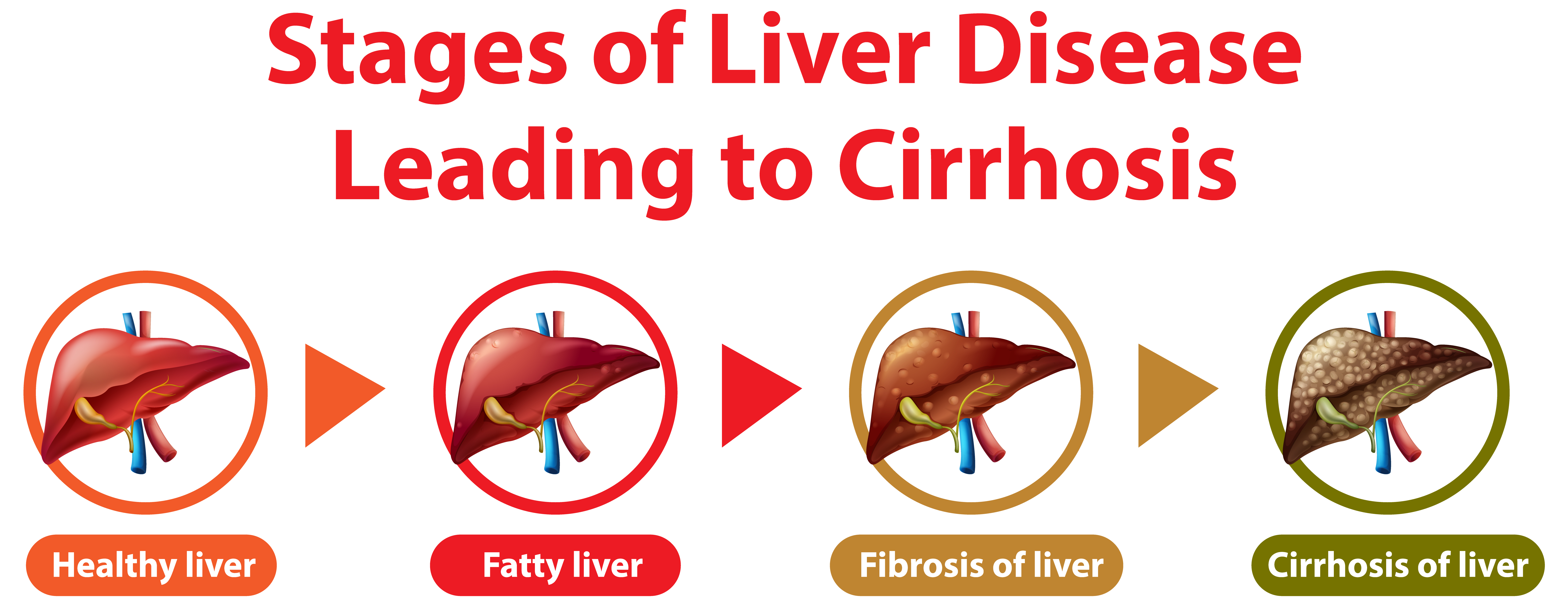 cirrhosis