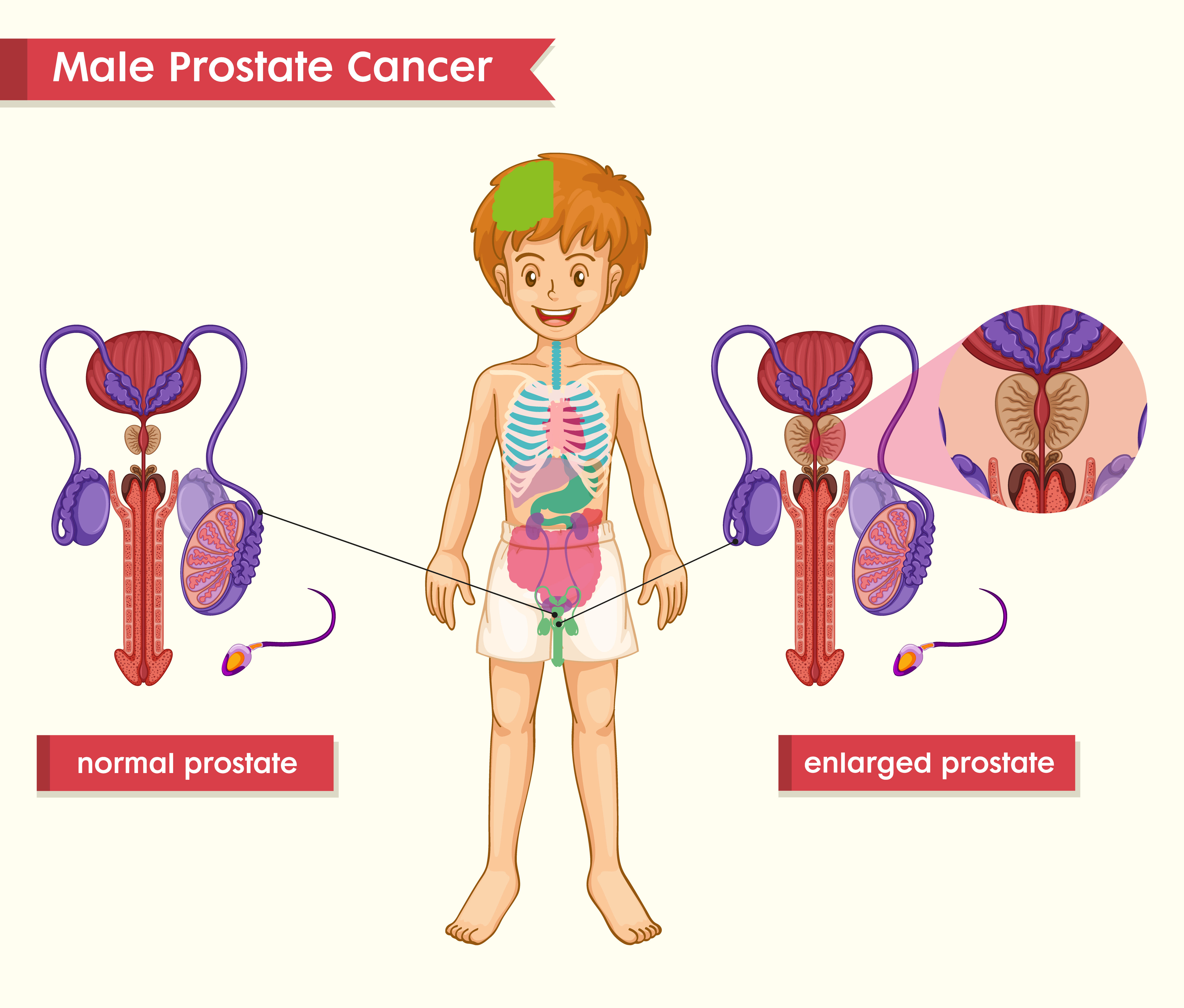 male prostate enlargement